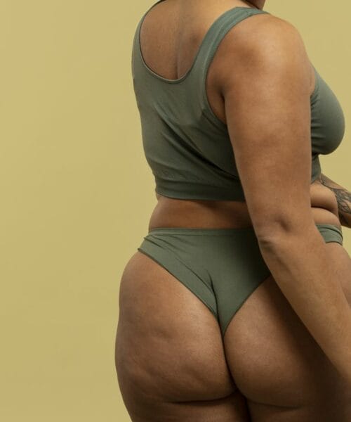 Dermatologista faz recomendações para mulheres que desejam combater e até acabar com as celulites